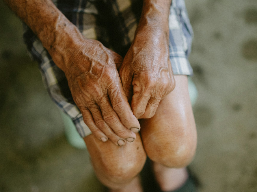 Nursing Home Bruising